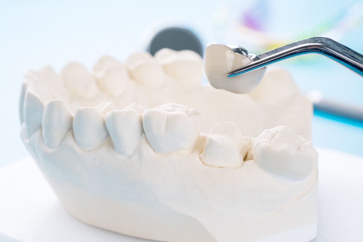 Types of Dental Crowns: Which One is Right for You?